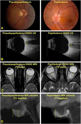 Comparison of Ocular Ultrasonography and Magnetic Resonance Imaging for Detection of Increased Intracranial Pressure